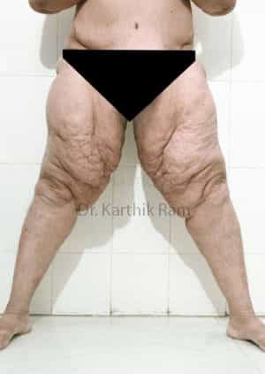 Thigh Lift