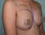 Breast Implants (Breast Augmentation)