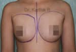 Breast Implants (Breast Augmentation)