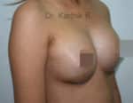 Breast Implants (Breast Augmentation)