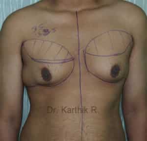 Gynecomastia (Puffy Nipples/ Male Chest Correction)