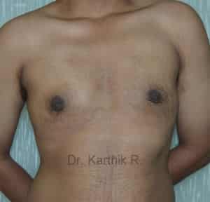 Gynecomastia (Puffy Nipples/ Male Chest Correction)