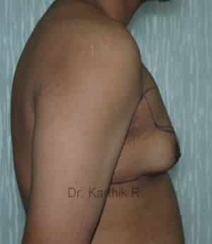 Gynecomastia (Puffy Nipples/ Male Chest Correction)