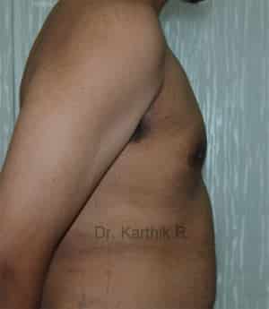 Gynecomastia (Puffy Nipples/ Male Chest Correction)