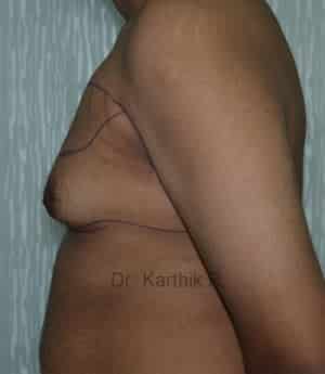 Gynecomastia (Puffy Nipples/ Male Chest Correction)