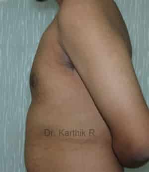 Gynecomastia (Puffy Nipples/ Male Chest Correction)