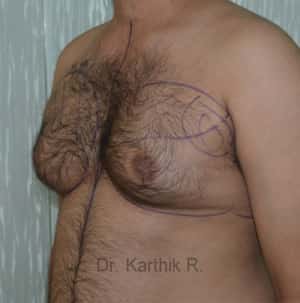 Gynecomastia (Puffy Nipples/ Male Chest Correction)