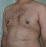 Gynecomastia (Puffy Nipples/ Male Chest Correction)