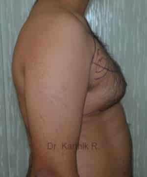 Gynecomastia (Puffy Nipples/ Male Chest Correction)