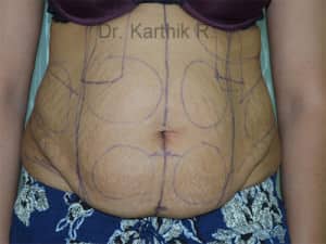 Tummy Tuck