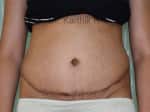 Tummy Tuck