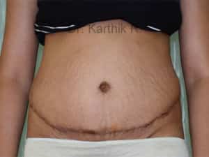 Tummy Tuck