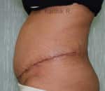 Tummy Tuck