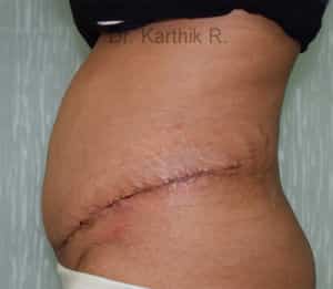 Tummy Tuck