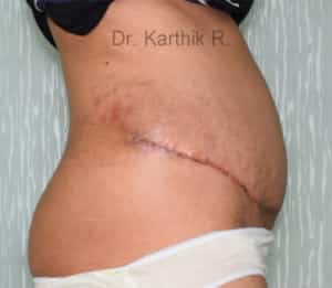 Tummy Tuck