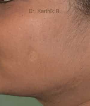 Fat Graft / Fat Fill/ Fat Transfer