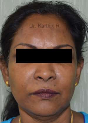 Fat Graft / Fat Fill/ Fat Transfer