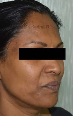 Fat Graft / Fat Fill/ Fat Transfer