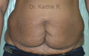 Tummy Tuck