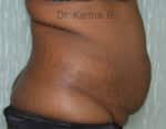 Tummy Tuck