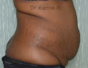 Tummy Tuck