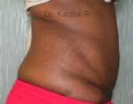 Tummy Tuck