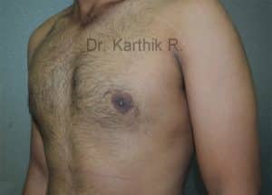 Gynecomastia (Puffy Nipples/ Male Chest Correction)