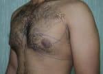 Gynecomastia (Puffy Nipples/ Male Chest Correction)