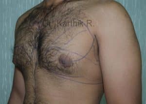 Gynecomastia (Puffy Nipples/ Male Chest Correction)