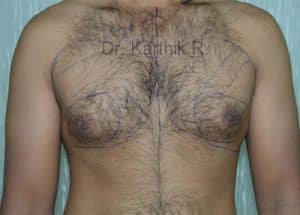 Gynecomastia (Puffy Nipples/ Male Chest Correction)