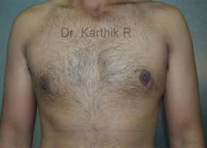 Gynecomastia (Puffy Nipples/ Male Chest Correction)