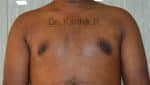 Gynecomastia (Puffy Nipples/ Male Chest Correction)