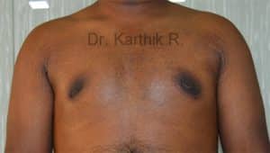 Gynecomastia (Puffy Nipples/ Male Chest Correction)