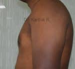 Gynecomastia (Puffy Nipples/ Male Chest Correction)