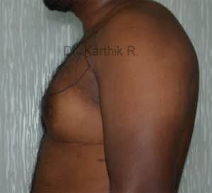 Gynecomastia (Puffy Nipples/ Male Chest Correction)