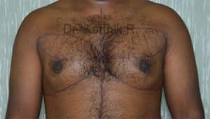 Gynecomastia (Puffy Nipples/ Male Chest Correction)