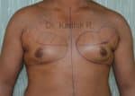 Gynecomastia (Puffy Nipples/ Male Chest Correction)