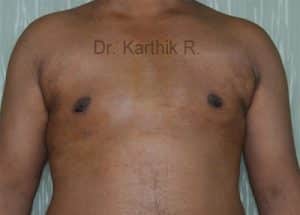 Gynecomastia (Puffy Nipples/ Male Chest Correction)