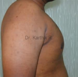 Gynecomastia (Puffy Nipples/ Male Chest Correction)