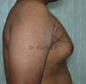 Gynecomastia (Puffy Nipples/ Male Chest Correction)