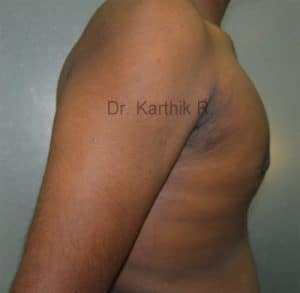 Gynecomastia (Puffy Nipples/ Male Chest Correction)
