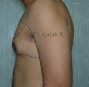Gynecomastia (Puffy Nipples/ Male Chest Correction)