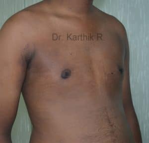 Gynecomastia (Puffy Nipples/ Male Chest Correction)