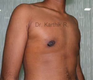 Gynecomastia (Puffy Nipples/ Male Chest Correction)