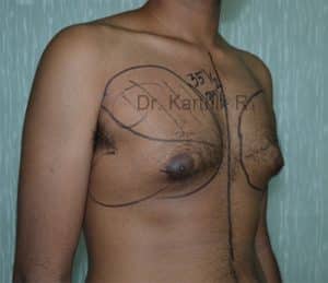 Gynecomastia (Puffy Nipples/ Male Chest Correction)