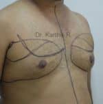 Gynecomastia (Puffy Nipples/ Male Chest Correction)