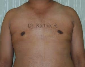 Gynecomastia (Puffy Nipples/ Male Chest Correction)