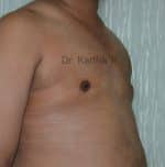 Gynecomastia (Puffy Nipples/ Male Chest Correction)