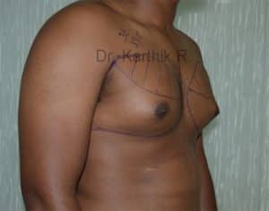 Gynecomastia (Puffy Nipples/ Male Chest Correction)