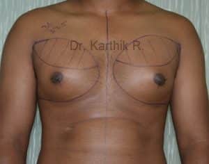 Gynecomastia (Puffy Nipples/ Male Chest Correction)